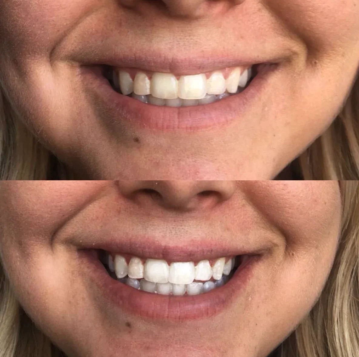 PREORDER: Cozy Smile Whitening Kit